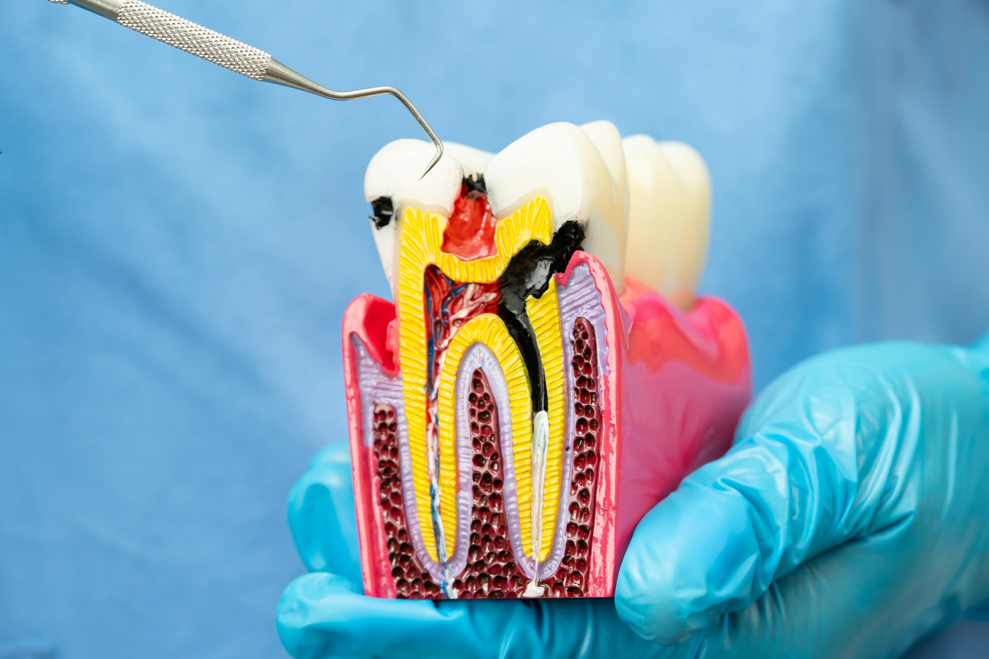 Asian dentist holding dental implant, artificial tooth roots into jaw, root canal of dental