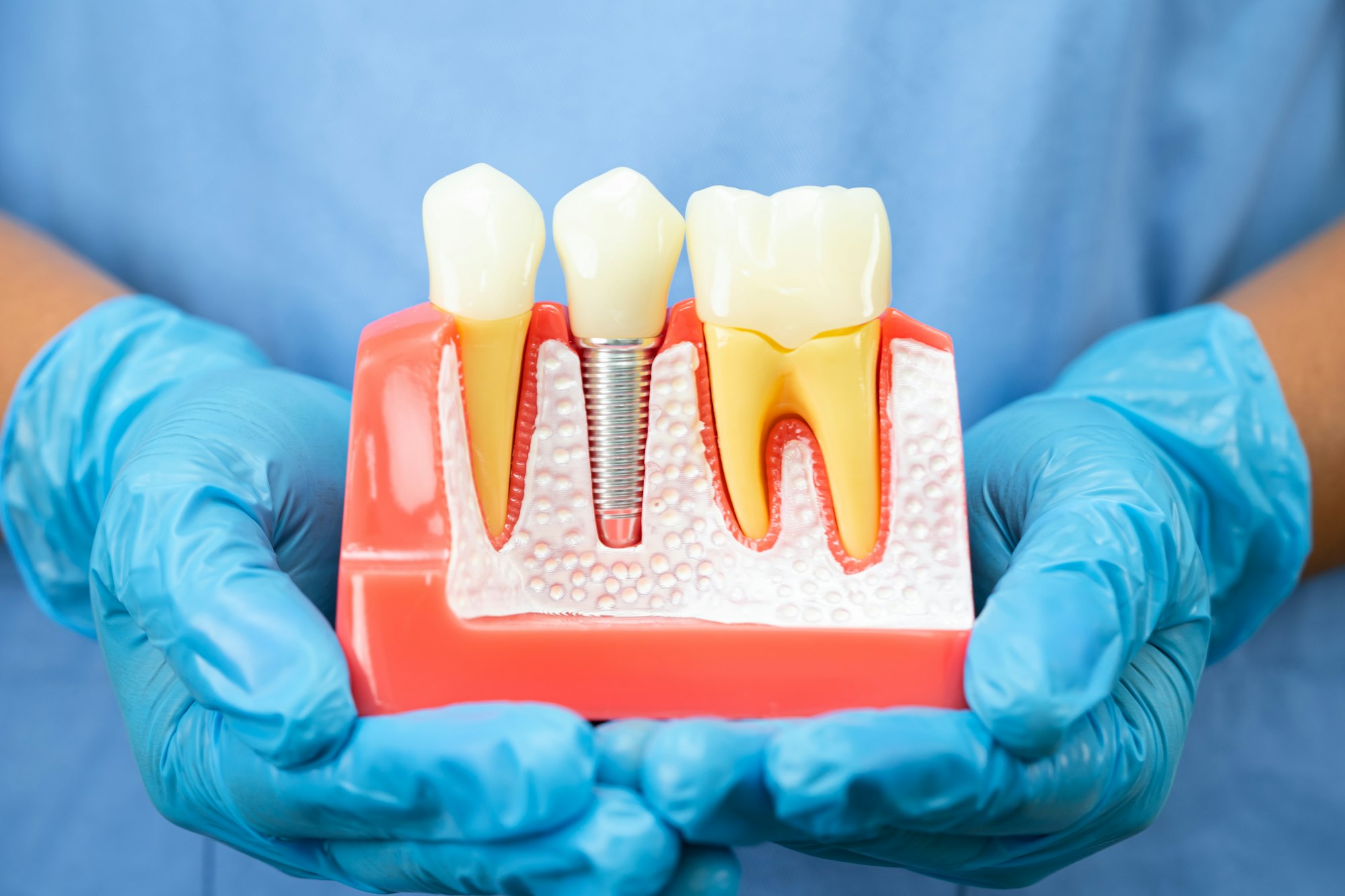 Asian dentist holding dental implant, artificial tooth roots into jaw, root canal