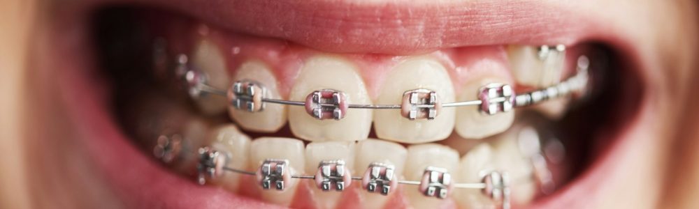 Shot of child's teeth with braces